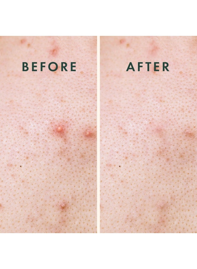 Rael Pimple Patches, Miracle XL Spot Control Cover - Extra Large Size for Back and Body, Korean Skincare, Hydrocolloid Acne Spot Treatment Patch, Vegan & Cruelty Free (8 Count) - Image 4